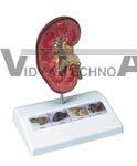 Kidney Stone Model